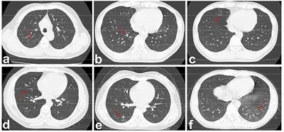 Clinical and Pulmonary CT Characteristics of Patients Infected With the SARS-CoV-2 Omicron Variant Compared With Those of Patients Infected With the Alpha Viral Strain